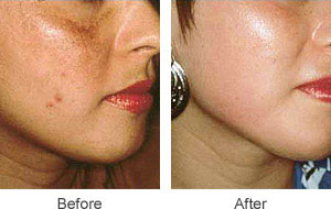 before and after Microdermabrasion facial